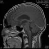 Ependymoma on the brain stem, October 9, 2010