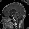 Ependymoma