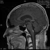 Ependymoma, remaining tumor on the brain stem