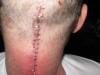 Ependymoma brain surgery